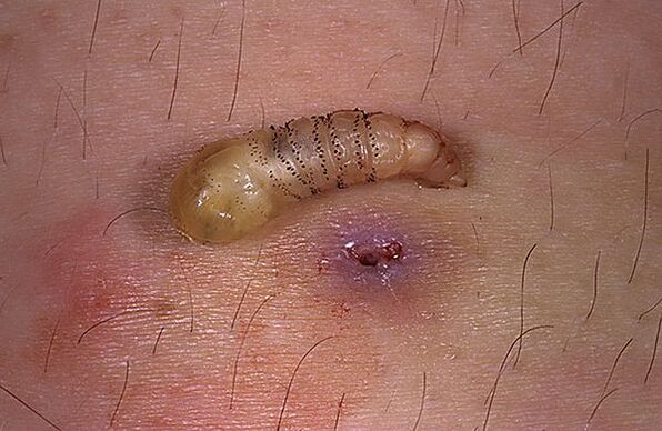 podkožní larva parazit člověka